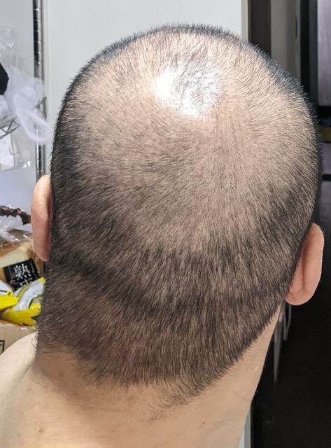 【画像】女さん「いいいやああああああ！かわいい女子の動画見てたらハゲが出てきたああああ」 | 【画像】女さん「いいいやああああああ！かわいい女子の動画見てたらハゲが出てきたああああ」 | 【画像】女さん「いいいやああああああ！かわいい女子の動画見てたらハゲが出てきたああああ」 | 【画像】女さん「いいいやああああああ！かわいい女子の動画見てたらハゲが出てきたああああ」 | 【画像】女さん「いいいやああああああ！かわいい女子の動画見てたらハゲが出てきたああああ」 | 【画像】女さん「いいいやああああああ！かわいい女子の動画見てたらハゲが出てきたああああ」 | やっちまった速報(画像19190528448608_6)