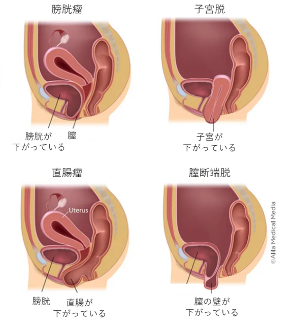 女さん（70）高齢でセ●クスにハマり膀胱、子宮、直腸が膣から飛び出るまでヤってしまう... | 女さん（70）高齢でセ●クスにハマり膀胱、子宮、直腸が膣から飛び出るまでヤってしまう... | 女さん（70）高齢でセ●クスにハマり膀胱、子宮、直腸が膣から飛び出るまでヤってしまう... | やっちまった速報(画像01221728277196_3)