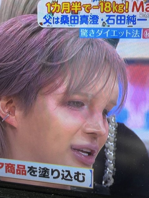 【整形】Matt、おでこが破裂しそう | 【整形】Matt、おでこが破裂しそう | 【整形】Matt、おでこが破裂しそう | やっちまった速報(画像31010826257803_3)
