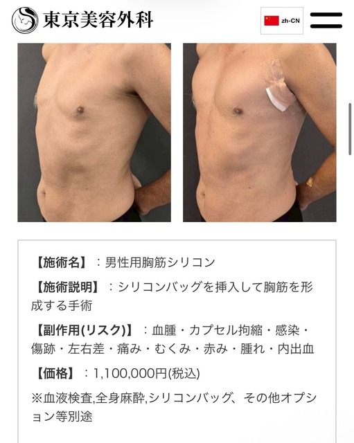 【画像】男の「筋肉整形」大ブームの兆しｗｗｗｗｗ | 【画像】男の「筋肉整形」大ブームの兆しｗｗｗｗｗ | 【画像】男の「筋肉整形」大ブームの兆しｗｗｗｗｗ | 【画像】男の「筋肉整形」大ブームの兆しｗｗｗｗｗ | 【画像】男の「筋肉整形」大ブームの兆しｗｗｗｗｗ | やっちまった速報(23105506695138_5)
