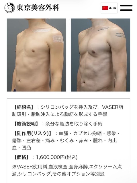 【画像】男の「筋肉整形」大ブームの兆しｗｗｗｗｗ | 【画像】男の「筋肉整形」大ブームの兆しｗｗｗｗｗ | 【画像】男の「筋肉整形」大ブームの兆しｗｗｗｗｗ | 【画像】男の「筋肉整形」大ブームの兆しｗｗｗｗｗ | 【画像】男の「筋肉整形」大ブームの兆しｗｗｗｗｗ | 【画像】男の「筋肉整形」大ブームの兆しｗｗｗｗｗ | やっちまった速報(23105507076608_6)